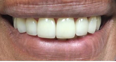 Chipped top teeth repaired